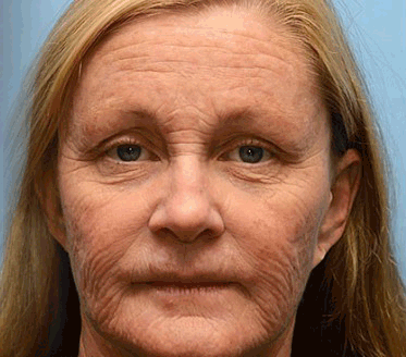 LiftingPro – Sérum Rejuvenescedor Efeito Botox